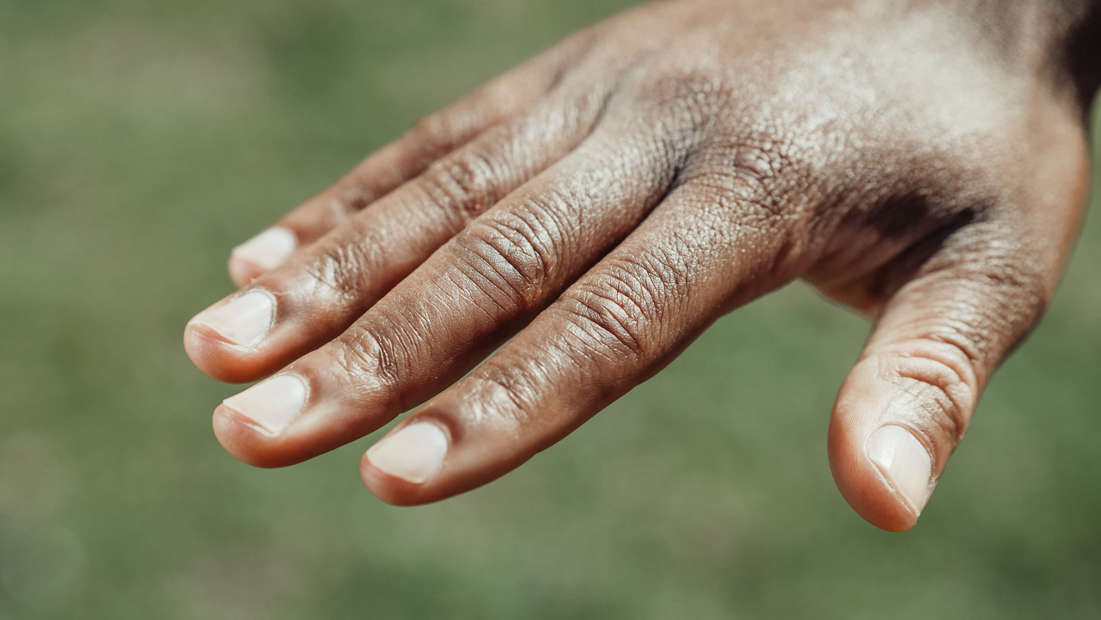 The Ultimate Guide to Eczema: