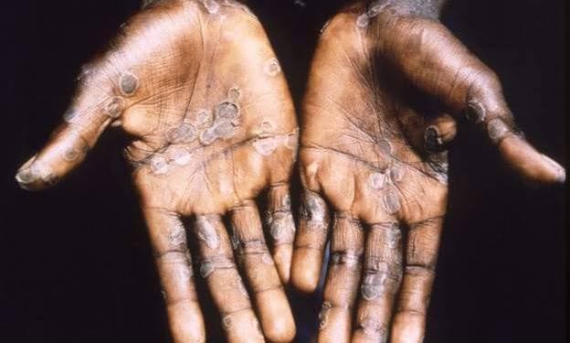 Ghana Confirms First Monkeypox Case of 2024 Amid Ongoing African Outbreak